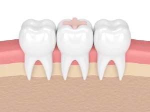 اكتشف حشوة اسنان تجميلية مميزة وتعرف على أهم 6 نصائح للحفاظ عليها !