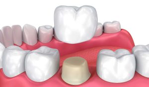 تعرف على كيفية خلع تركيبة الاسنان وما هو أفضل مركز للقيام بهذا الإجراء؟