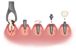 اكتشف معلومات عن زراعة الاسنان كم تستغرق وما هي أهم الخطوات فيها؟