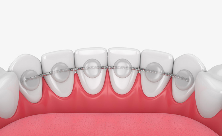 هل مثبت الأسنان بعد التقويم يعدل الأسنان ؟