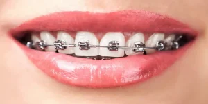 تعرف على شكل التقويم الاسنان وأفضل مركز طبي يمكن القيام به فيه؟