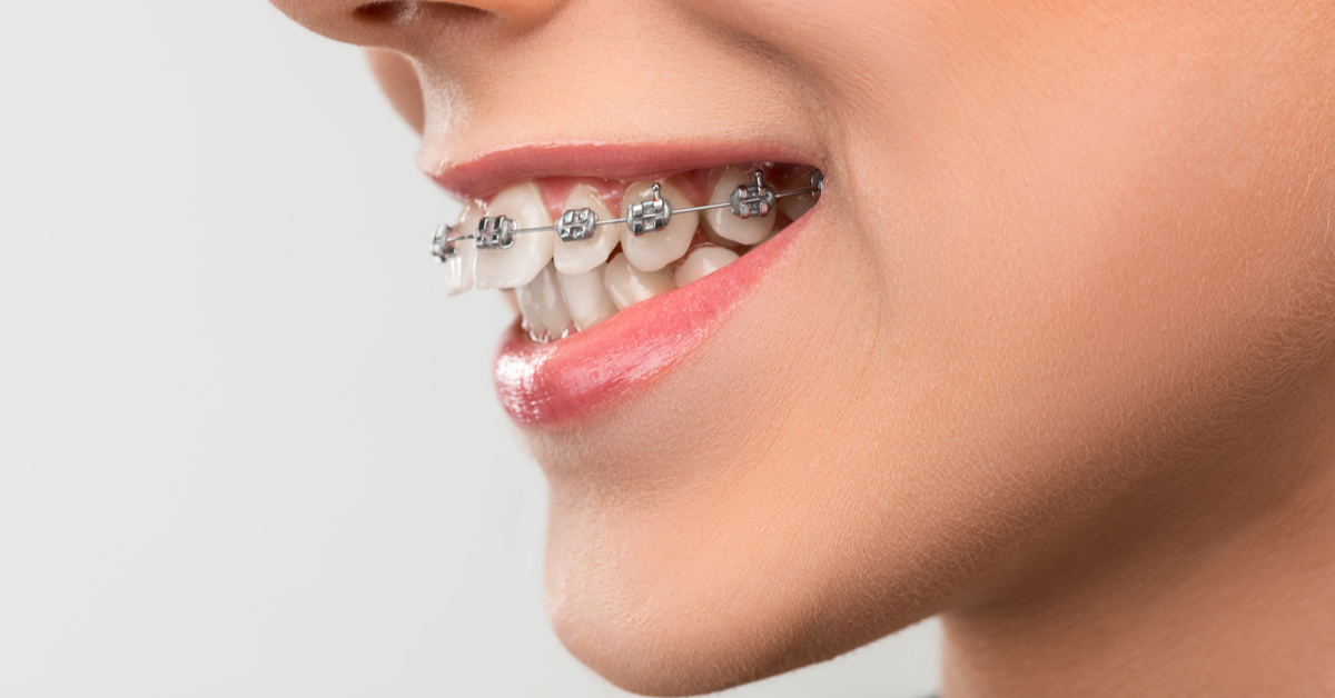 طرق علاج بروز الأسنان بالتقويم