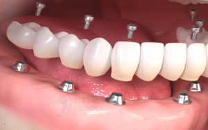 تعرف على طريقة زراعة الاسنان الفورية وما هي أبرز مميزاتها؟