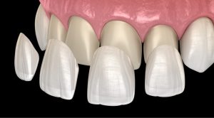قشرة البورسلين للأسنان وما هو الفرق بينه والزيركون؟ 