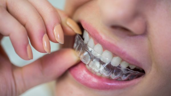 كيفية ترتيب الاسنان بدون تقويم