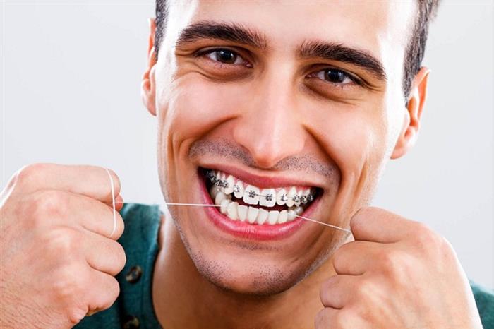 كيفية تركيب تقويم الاسنان السفلية