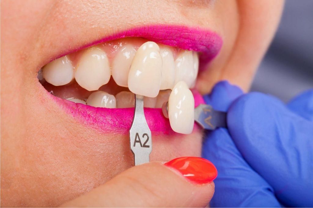 كيفية تعديل الاسنان بدون تقويم