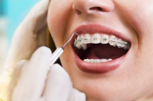 اكتشف ما فائدة تقويم الاسنان؟ وكيف يمكن تنظيف الأسنان مع وجود التقويم؟