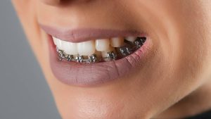 متى تبدا تتحرك الاسنان بعد تركيب التقويم وكيف يمكن أن يكون تأثير التقويم على الأسنان؟