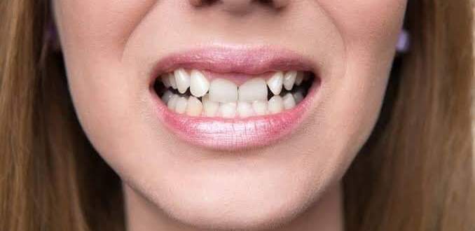 نصائح لتصحيح الاسنان في المنزل أثناء مرحلة ما قبل البلوغ