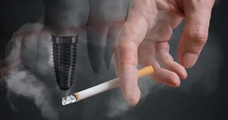 هل يقلل التدخين نسبة نجاح عملية زراعة الأسنان؟