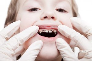 اكتشف أهم وأبرز مشاكل اسنان الاطفال ومعلومات مميزة عن جدول التسنين لديهم!