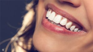 اكتشف معنا ما الفرق بين عدسات الأسنان وابتسامة هوليود!