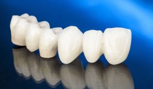 ما هي انواع تركيبات الاسنان الزيركون وأهم ما يميزها؟