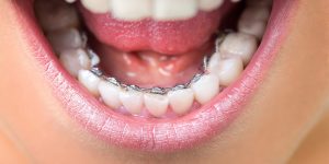 معلومات مميزة عن تقويم الاسنان اللساني وما هي أبرز وأهم أنواعه؟