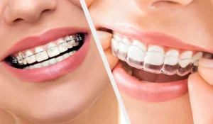 تعرف إلى تقويم الاسنان كم ياخذ وقت وما هي أبرز مميزاته؟
