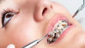 تعرف على حالات تقويم الأسنان وما هي شروط القايم بهذا الإجراء؟