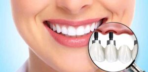 هل زرع الاسنان يسبب السرطان وما أهم مخاطر هذا الإجراء؟