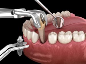 كيف طريقة زراعة الاسنان وما هي علامات فشلها؟