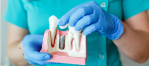 استكشف مساوئ زراعة الأسنان وما هي أسباب اللجوء إليها؟
