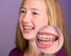 تعرف على أنواع مطاط تقويم الاسنان وأهم 5 فوائد له!