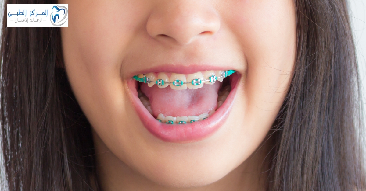 Braces for Girls