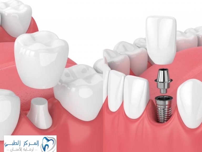 Which is better dental implants or bridge? What is the best medical