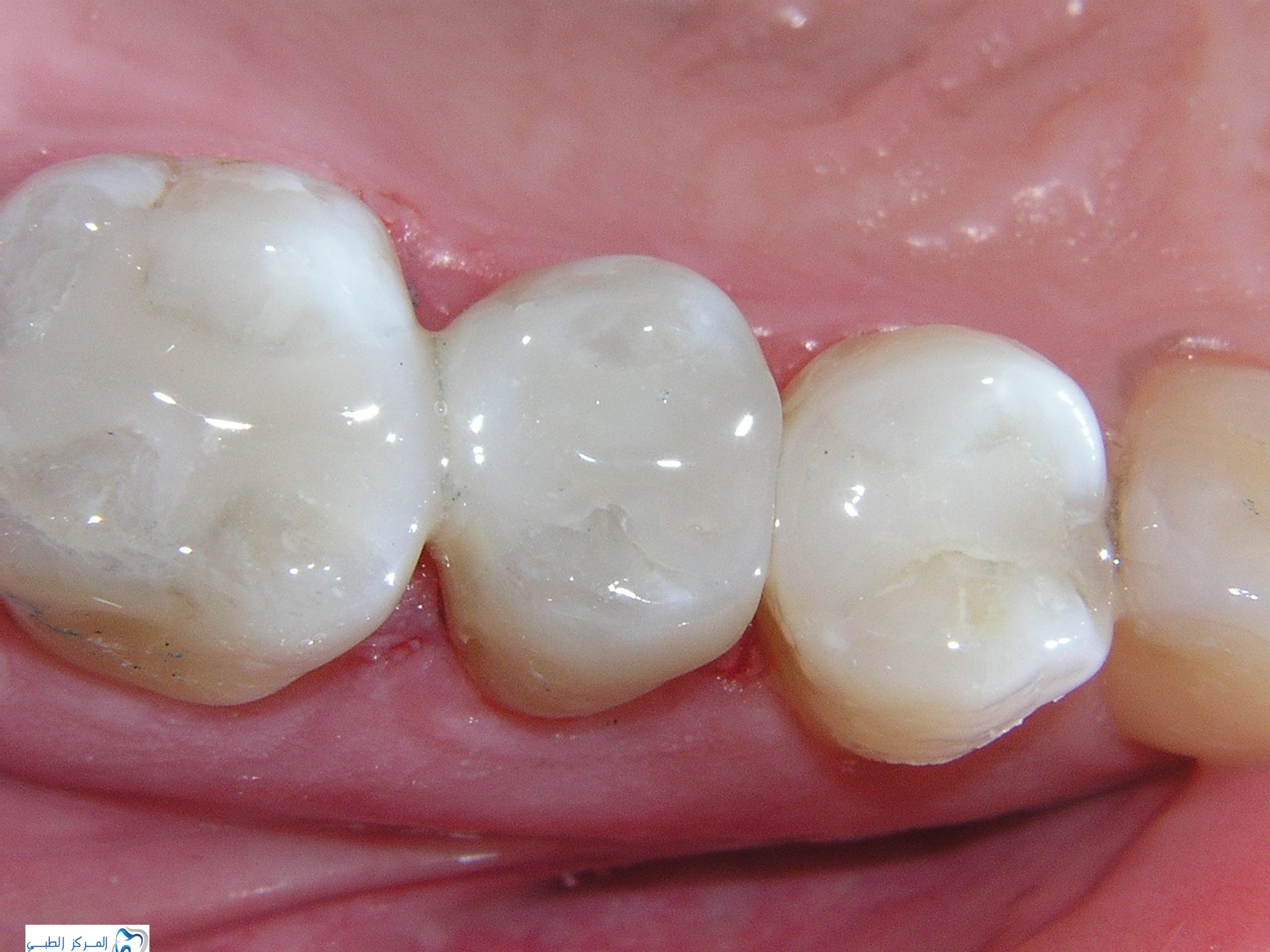 What causes tooth pain after a filling, and how to deal with it