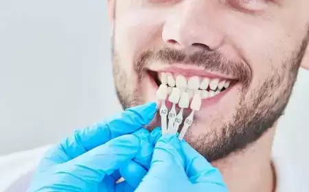 ڤينير الأسنان