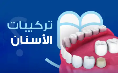 تركيبات الأسنان
