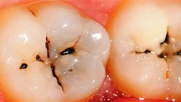 علاج تسوس الأسنان فى المراحل المبكرة والمتقدمة - اليوم السابع